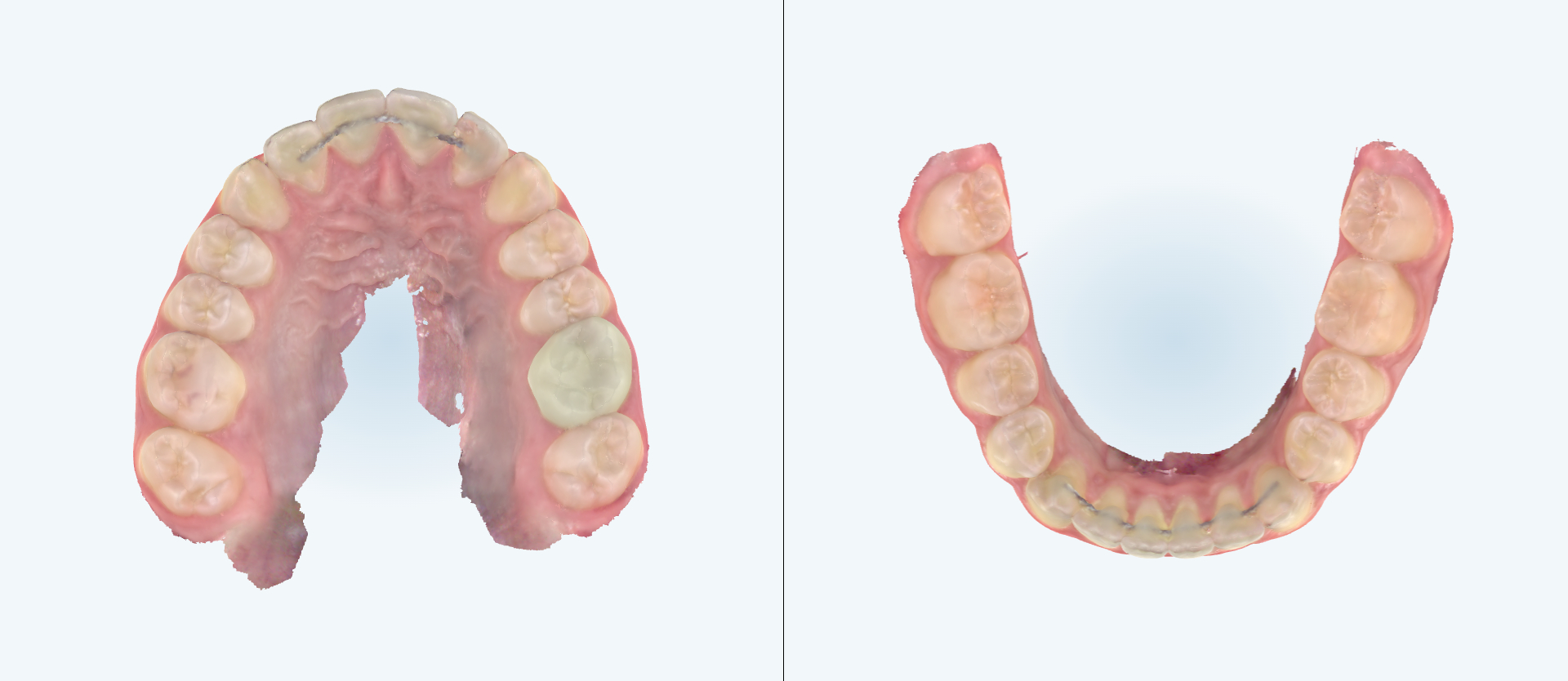 Crowding treatment comparison case 2 after